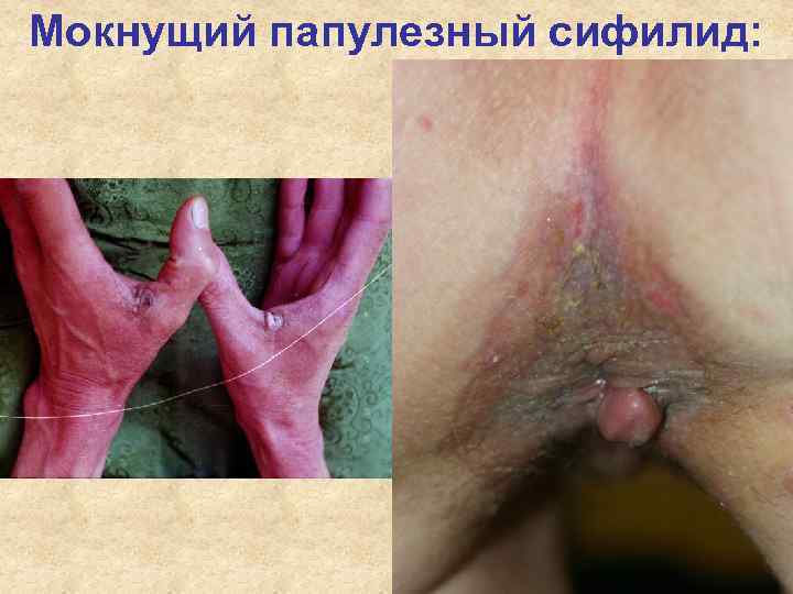 Мокнущий папулезный сифилид: Мокнущий папулезный сифилид: