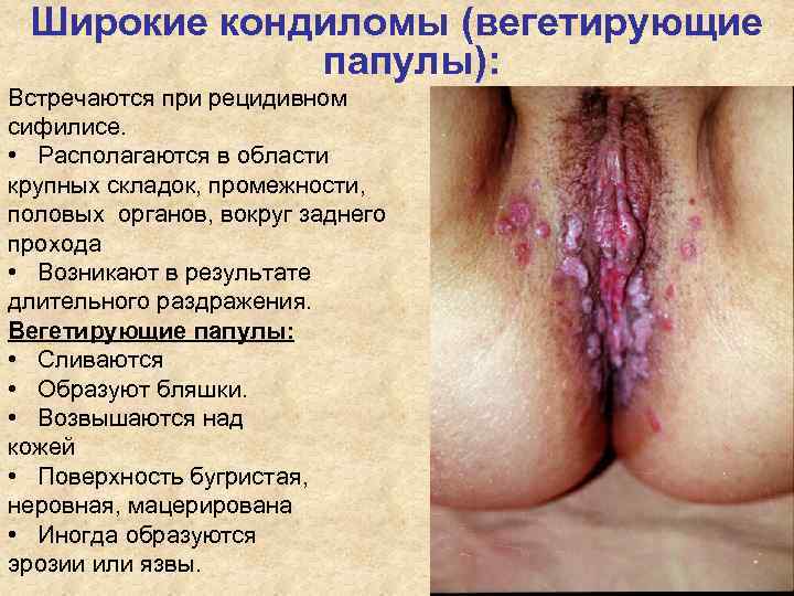 Широкие кондиломы (вегетирующие папулы): Встречаются при рецидивном сифилисе. • Располагаются Широкие кондиломы (вегетирующие папулы): Встречаются при рецидивном сифилисе. • Располагаются