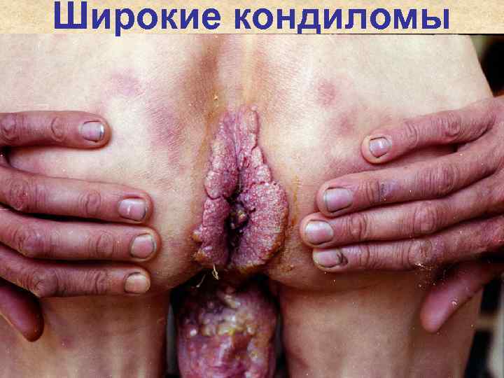 Широкие кондиломы Широкие кондиломы