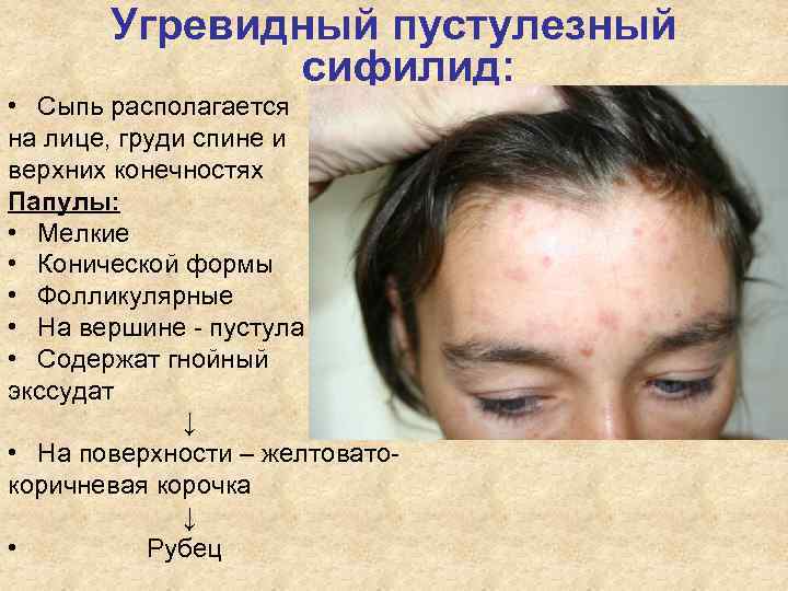 Угревидный пустулезный сифилид: • Сыпь располагается на лице, Угревидный пустулезный сифилид: • Сыпь располагается на лице,