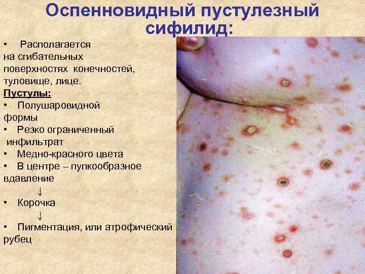 Оспенновидный пустулезный сифилид: • Располагается на сгибательных поверхностях конечностей, Оспенновидный пустулезный сифилид: • Располагается на сгибательных поверхностях конечностей,