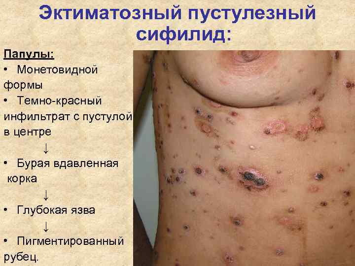 Эктиматозный пустулезный сифилид: Папулы: • Монетовидной формы • Темно-красный инфильтрат Эктиматозный пустулезный сифилид: Папулы: • Монетовидной формы • Темно-красный инфильтрат