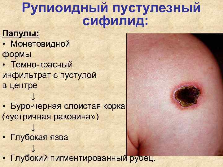 Рупиоидный пустулезный сифилид: Папулы: • Монетовидной формы • Темно-красный инфильтрат Рупиоидный пустулезный сифилид: Папулы: • Монетовидной формы • Темно-красный инфильтрат