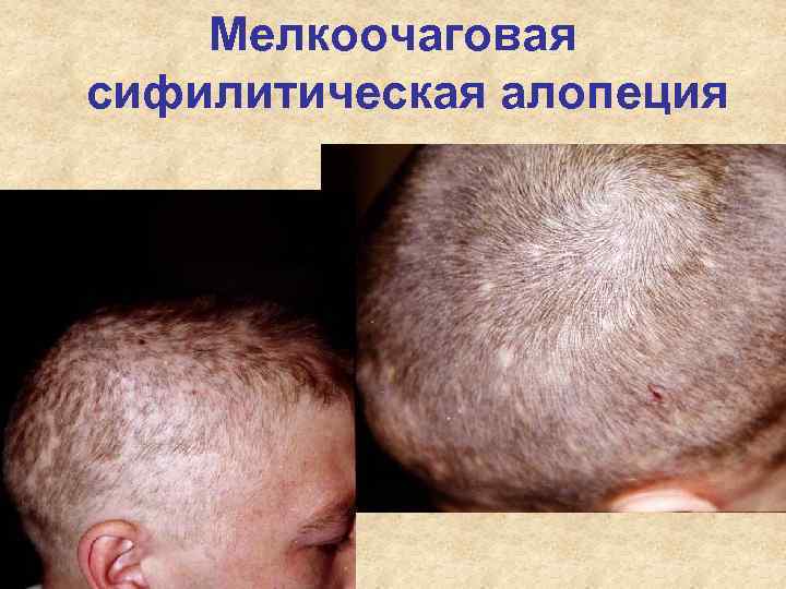 Мелкоочаговая сифилитическая алопеция Мелкоочаговая сифилитическая алопеция
