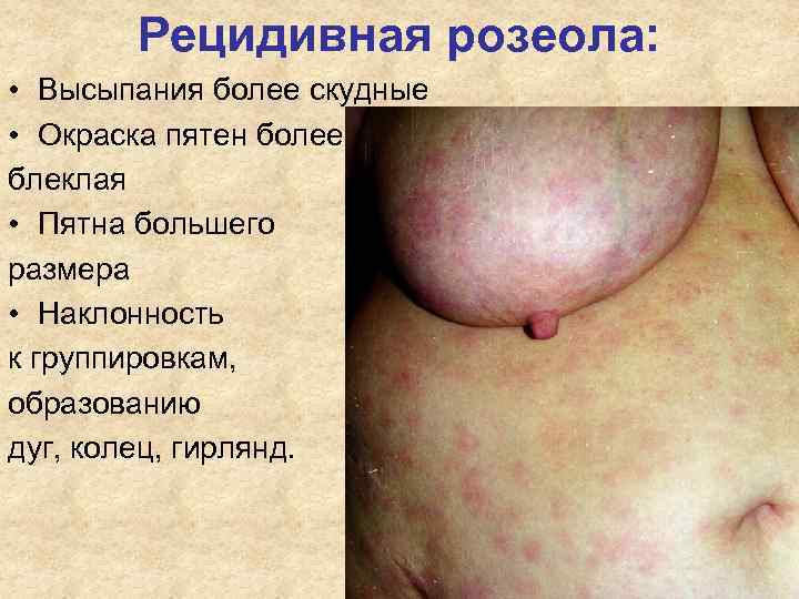 Рецидивная розеола: • Высыпания более скудные • Окраска пятен более блеклая Рецидивная розеола: • Высыпания более скудные • Окраска пятен более блеклая