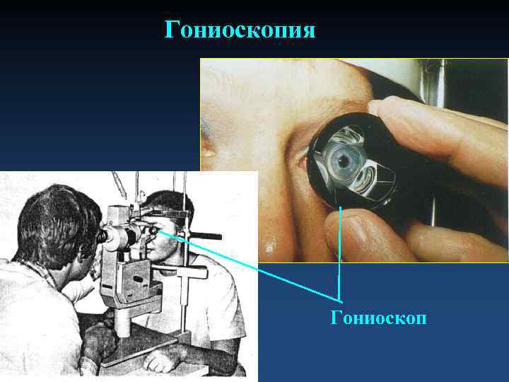 Гониоскопия    Гониоскоп 
