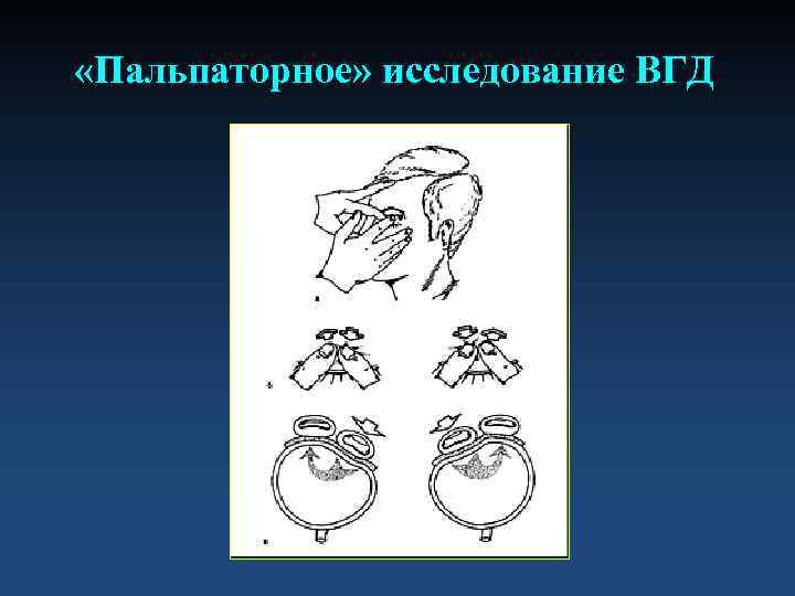  «Пальпаторное» исследование ВГД 