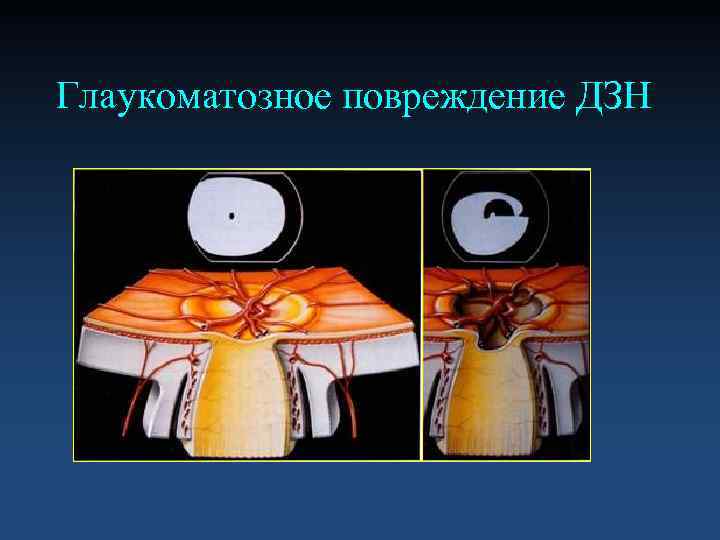 Глаукоматозное повреждение ДЗН 