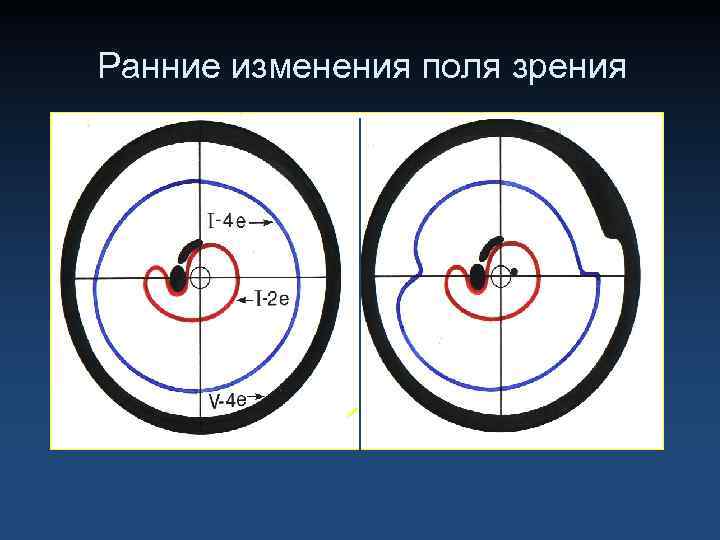 Ранние изменения поля зрения 