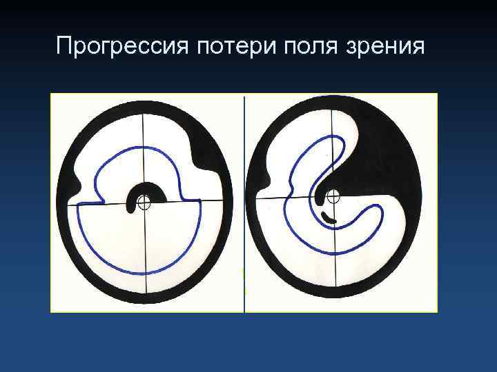 Прогрессия потери поля зрения 
