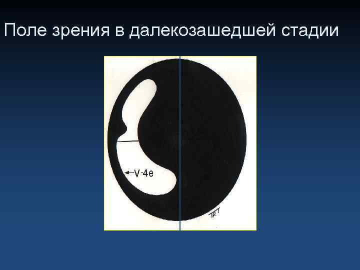 Поле зрения в далекозашедшей стадии 