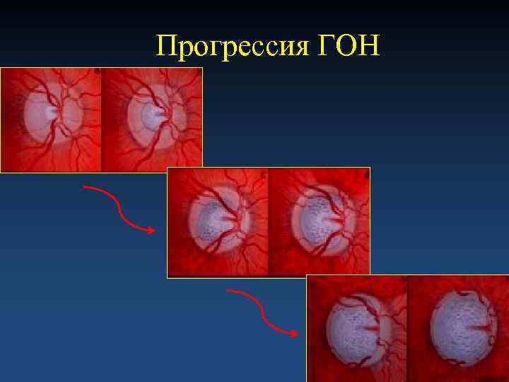 Прогрессия ГОН 