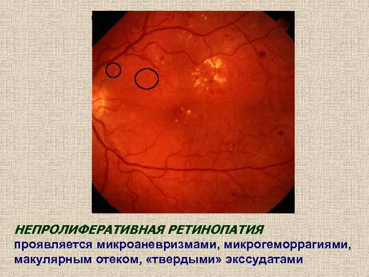 НЕПРОЛИФЕРАТИВНАЯ РЕТИНОПАТИЯ проявляется микроаневризмами, микрогеморрагиями, макулярным отеком,  «твердыми» экссудатами 