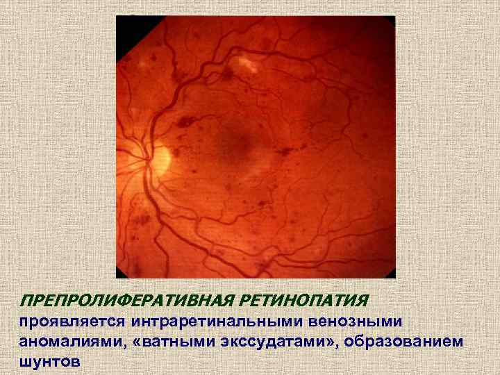 ПРЕПРОЛИФЕРАТИВНАЯ РЕТИНОПАТИЯ проявляется интраретинальными венозными аномалиями,  «ватными экссудатами» , образованием шунтов 