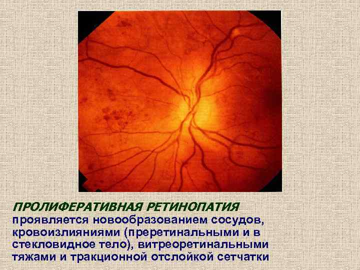 ПРОЛИФЕРАТИВНАЯ РЕТИНОПАТИЯ проявляется новообразованием сосудов, кровоизлияниями (преретинальными и в стекловидное тело), витреоретинальными тяжами и