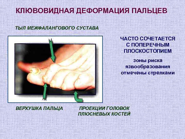 КЛЮВОВИДНАЯ ДЕФОРМАЦИЯ ПАЛЬЦЕВ ТЫЛ МЕЖФАЛАНГОВОГО СУСТАВА       ЧАСТО СОЧЕТАЕТСЯ