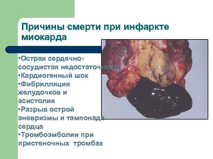 Причины смерти при инфаркте миокарда  • Острая сердечно- сосудистая недостаточность • Кардиогенный шок