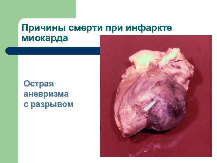 Причины смерти при инфаркте миокарда  Острая аневризма с разрывом 