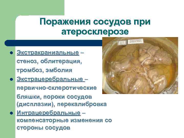    Поражения сосудов при    атеросклерозе l  Экстракраниальные –