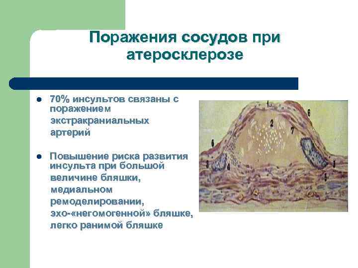   Поражения сосудов при    атеросклерозе l  70% инсультов связаны