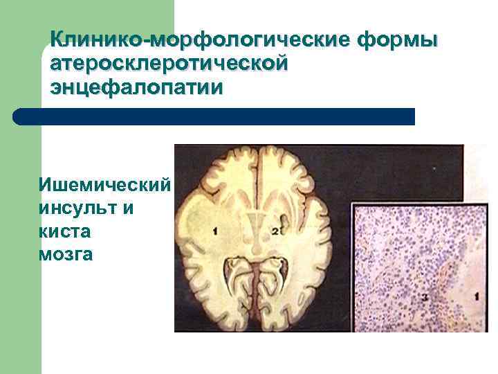 Клинико-морфологические формы атеросклеротической энцефалопатии  Ишемический инсульт и киста мозга 