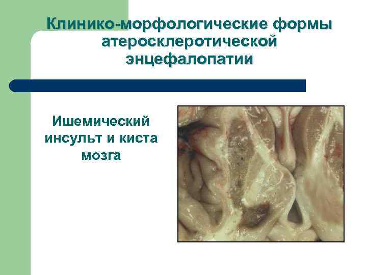 Клинико-морфологические формы  атеросклеротической   энцефалопатии  Ишемический инсульт и киста мозга 