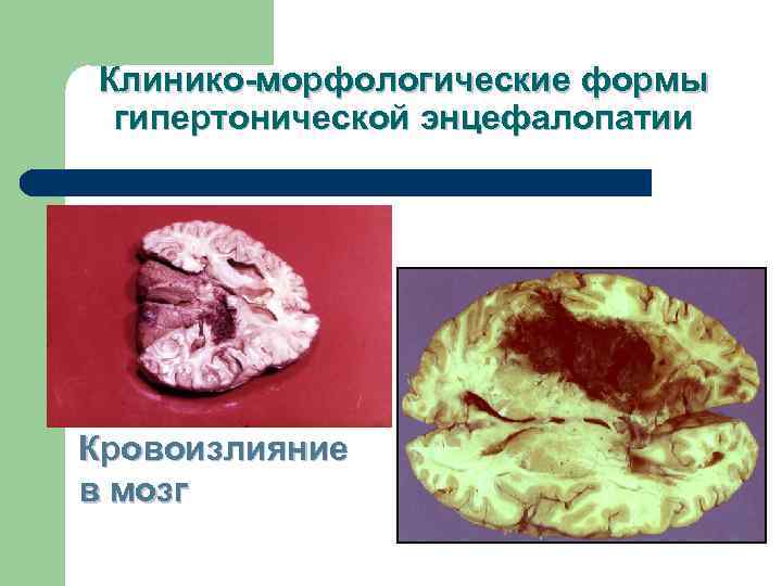 Клинико-морфологические формы гипертонической энцефалопатии Кровоизлияние в мозг 