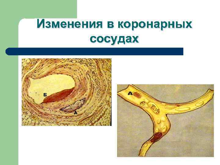 Изменения в коронарных  сосудах 