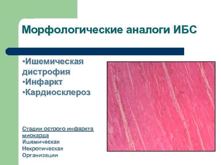 Морфологические аналоги ИБС  • Ишемическая дистрофия • Инфаркт • Кардиосклероз  Стадии острого