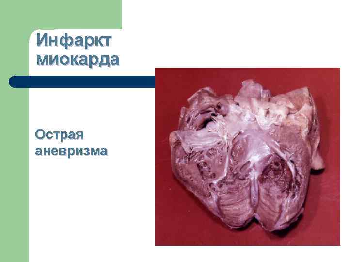 Инфаркт миокарда  Острая аневризма 
