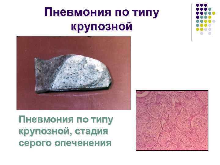   Пневмония по типу   крупозной Пневмония по типу крупозной, стадия серого