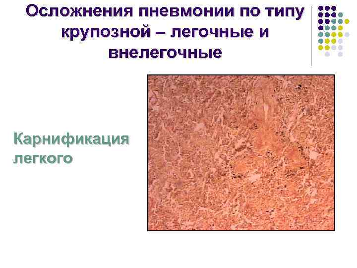  Осложнения пневмонии по типу крупозной – легочные и   внелегочные  Карнификация