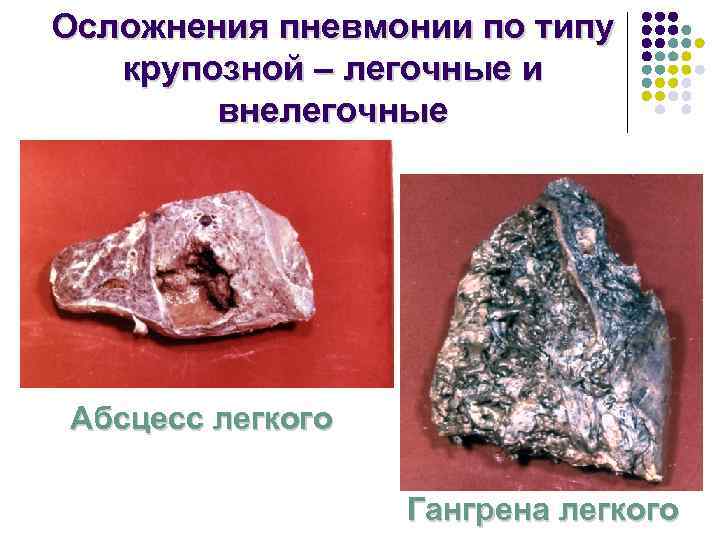 Осложнения пневмонии по типу  крупозной – легочные и   внелегочные Абсцесс легкого