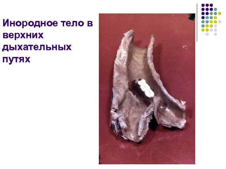 Инородное тело в верхних дыхательных путях 