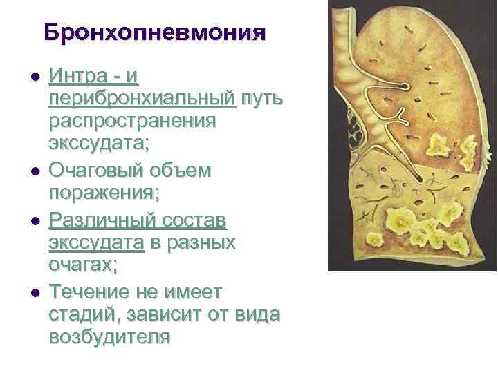   Бронхопневмония l  Интра - и перибронхиальный путь распространения экссудата; l 