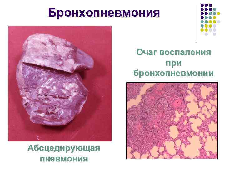   Бронхопневмония    Очаг воспаления    при  
