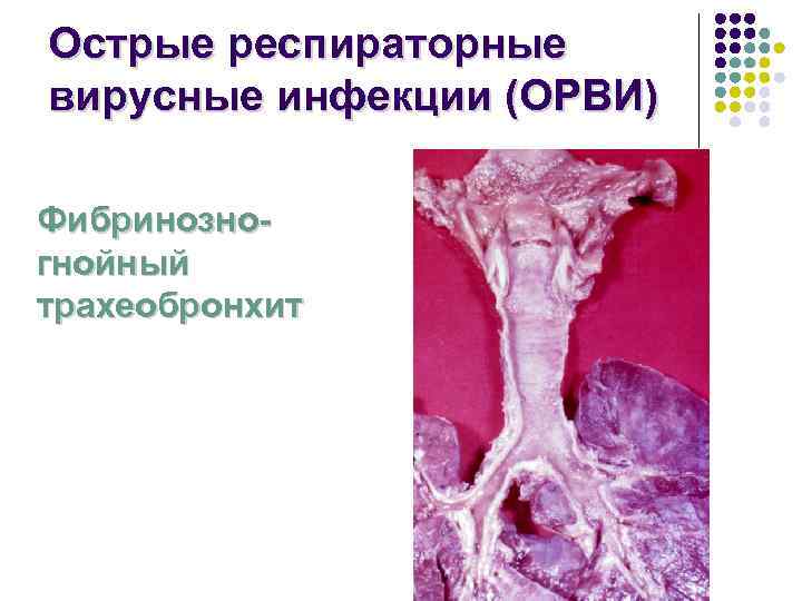 Острые респираторные вирусные инфекции (ОРВИ) Фибринозно- гнойный трахеобронхит 