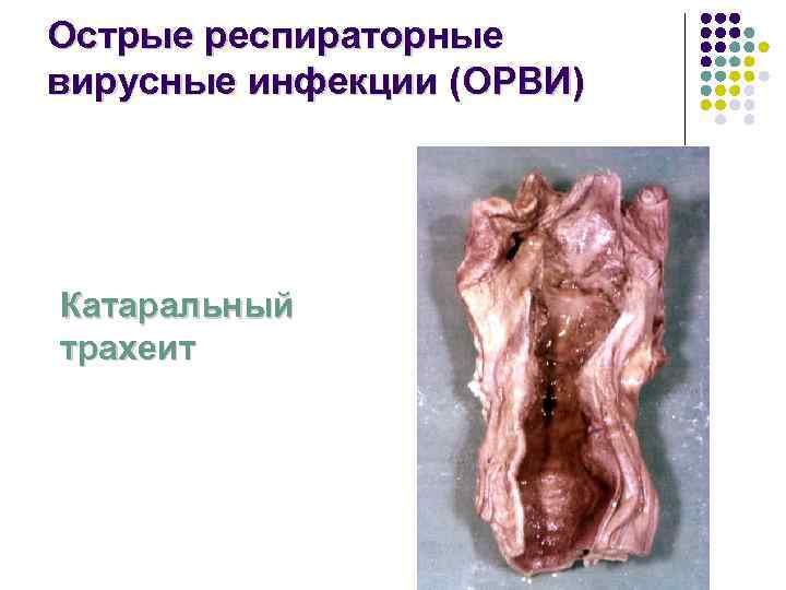 Острые респираторные вирусные инфекции (ОРВИ) Катаральный трахеит 