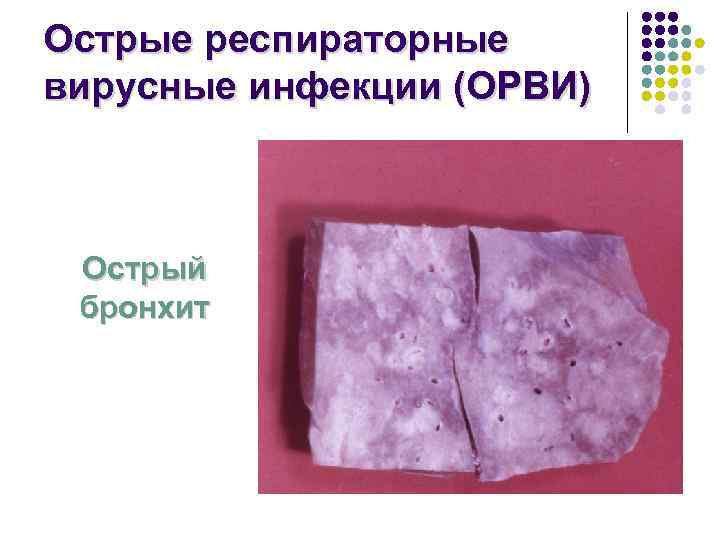 Острые респираторные вирусные инфекции (ОРВИ) Острый бронхит 