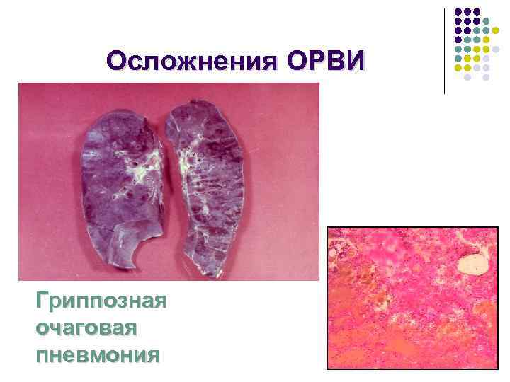  Осложнения ОРВИ Гриппозная очаговая пневмония 