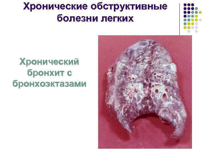  Хронические обструктивные  болезни легких Хронический  бронхит с бронхоэктазами 