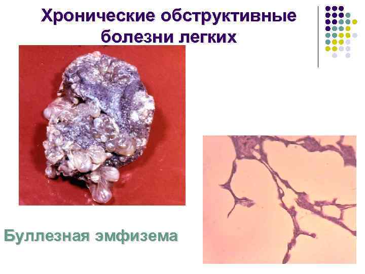   Хронические обструктивные   болезни легких Буллезная эмфизема 
