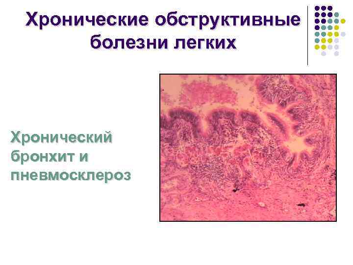  Хронические обструктивные  болезни легких  Хронический бронхит и пневмосклероз 