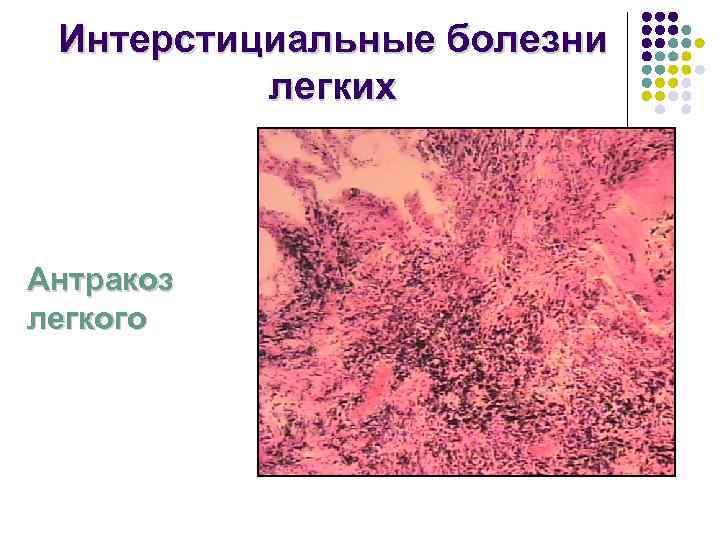 Антракоз профессиональное заболевание презентация