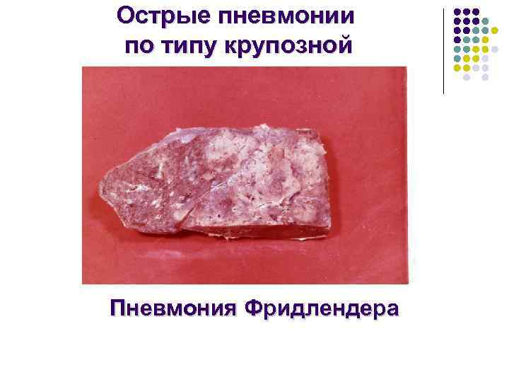 Острые пневмонии по типу крупозной Пневмония Фридлендера 