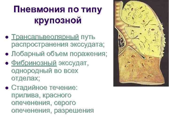   Пневмония по типу   крупозной l  Трансальвеолярный путь распространения экссудата;