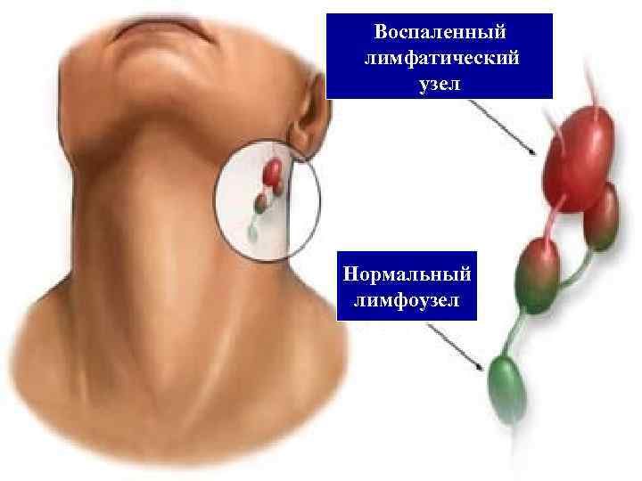  Воспаленный лимфатический  узел Нормальный лимфоузел 