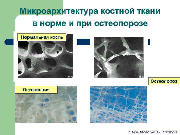 Микроархитектура костной ткани  в норме и при остеопорозе Нормальная кость   