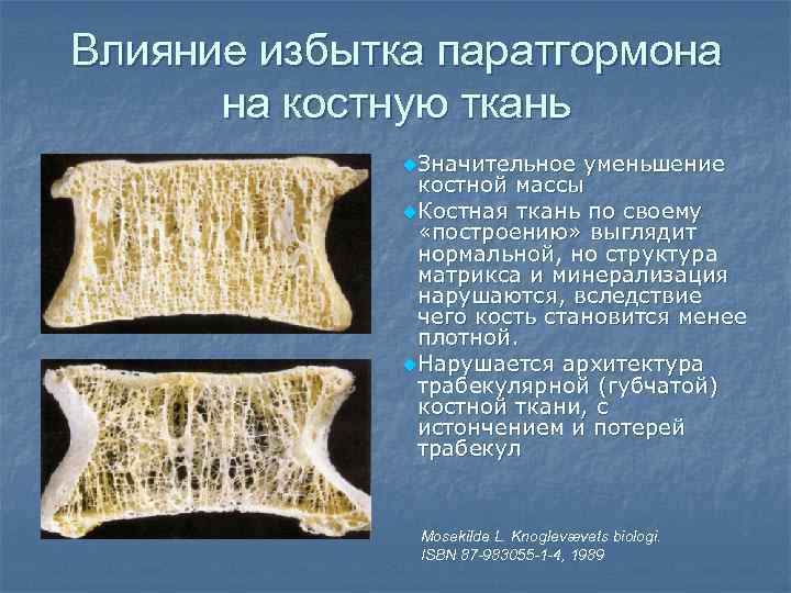 Влияние избытка паратгормона  на костную ткань    u. Значительное уменьшение 