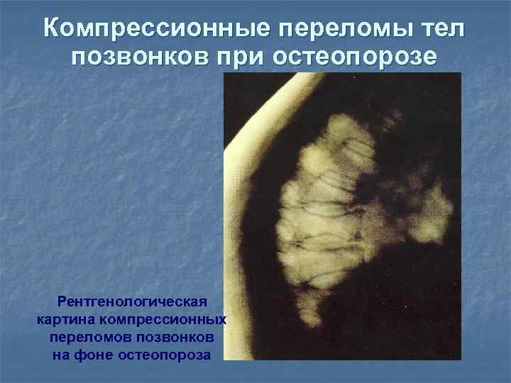 Компрессионные переломы тел  позвонков при остеопорозе  Рентгенологическая картина компрессионных  переломов позвонков